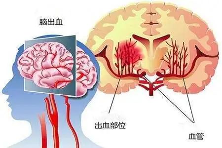 脑出血后遗症的症状表现