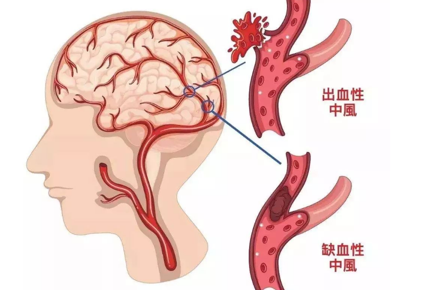 脑梗后遗症应该如何治疗?