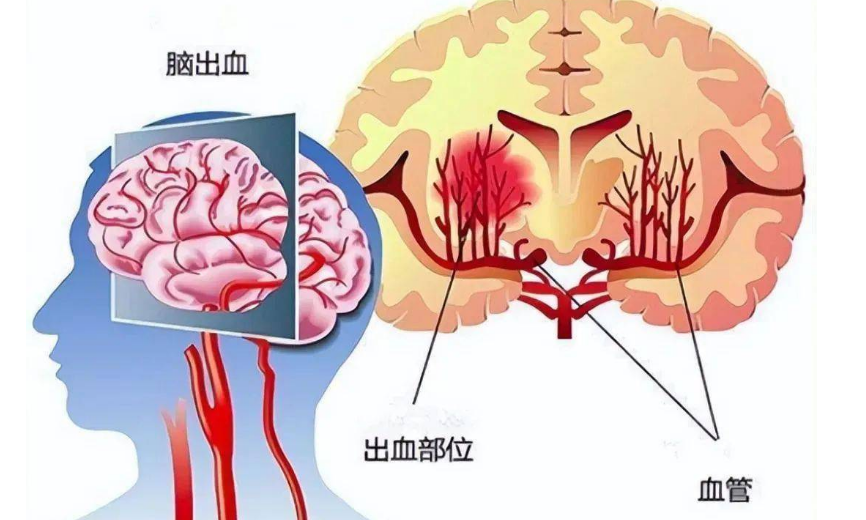 脑出血后遗症要怎样治疗?
