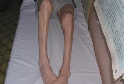肌肉萎缩锻炼方法有哪些?