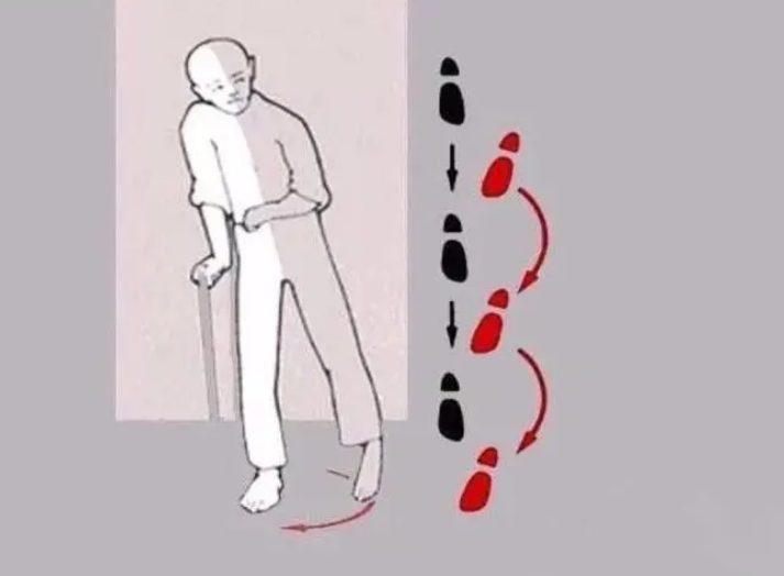 偏瘫步态是怎么回事?
