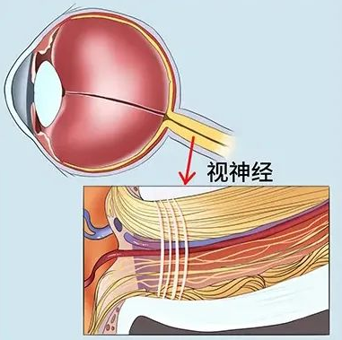 视神经萎缩如何才能恢复?