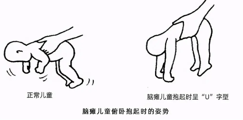 痉挛型脑瘫剪刀脚怎么治疗?