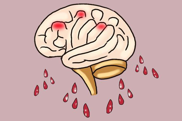 脑出血后遗症要怎样治疗?