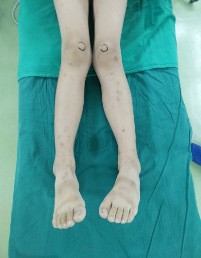 怎样区分生理性和病理性膝外翻?应如何矫正?