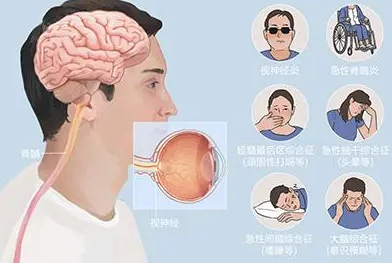 视神经脊髓炎的治疗方法