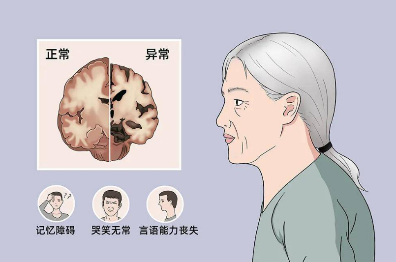 脑萎缩后头晕如何缓解?