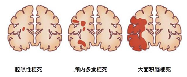 脑梗后遗症多久能恢复？剖析影响脑梗后遗症恢复时间的关键因素