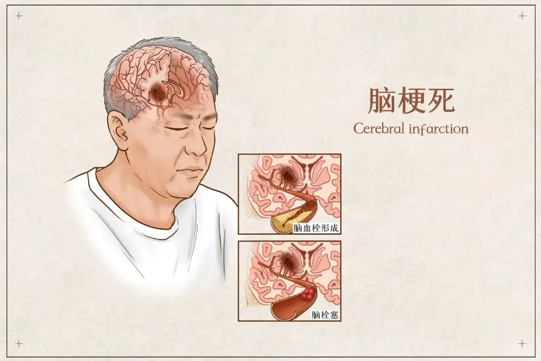 正值壮年,记忆力骤降:警惕脑梗的隐形信号