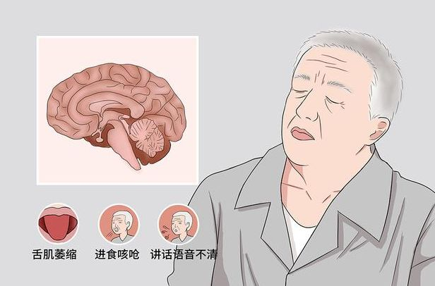 运动神经元病患者出现排便困难怎么办?这些运动方式和习惯可帮助缓解