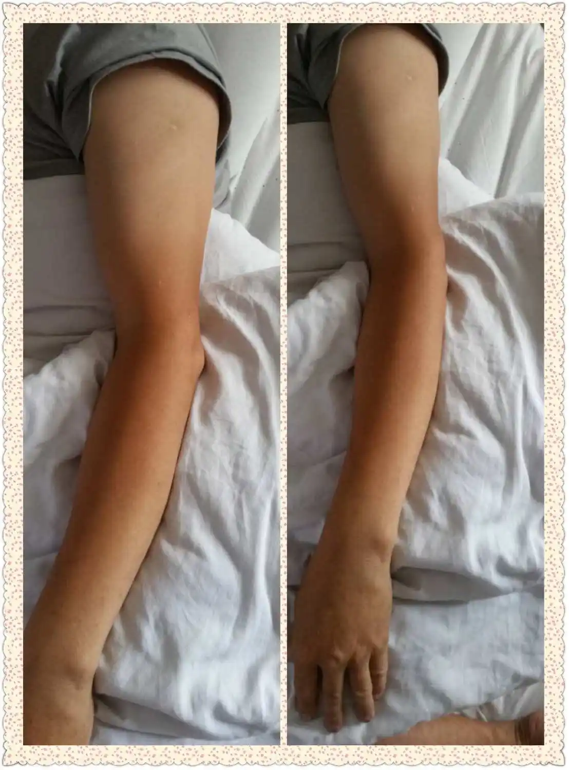 肌肉萎缩和肌无力的区别和联系,如何预防肌肉萎缩?