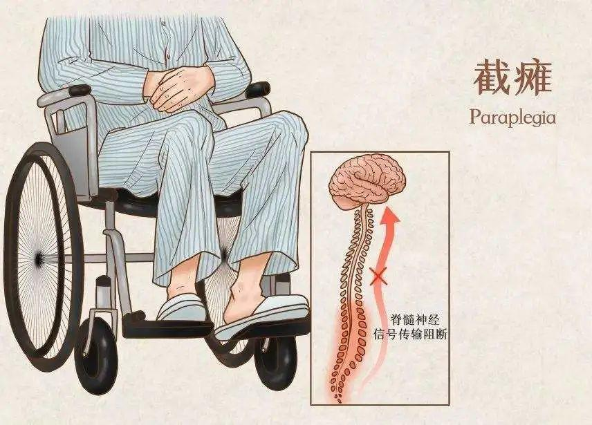 截瘫患者如何预防肌肉?常做这四动作守护肌肉健康