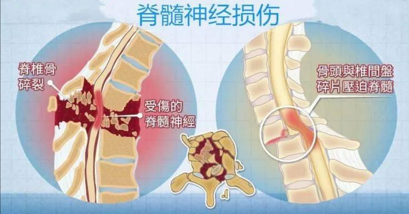 哪些迹象表明受损神经在恢复中?