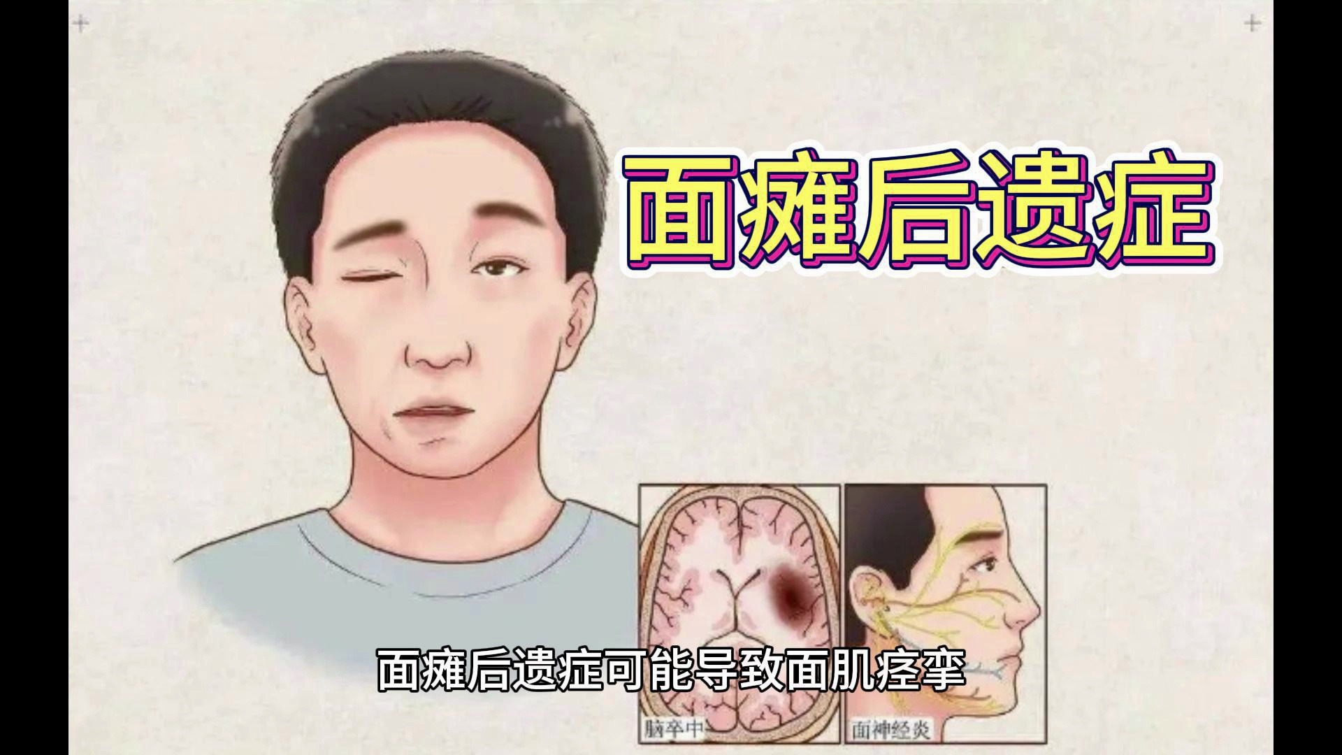 面瘫康复后的隐形挑战:后遗症的识别与治疗