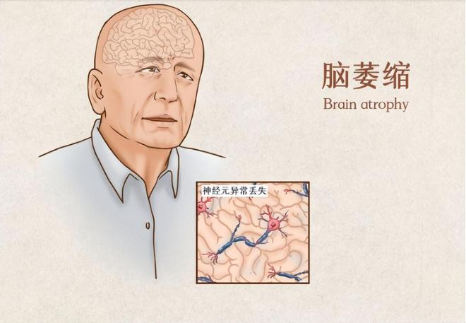从蹒跚到跌倒:小脑萎缩对身体协调的渐进影响