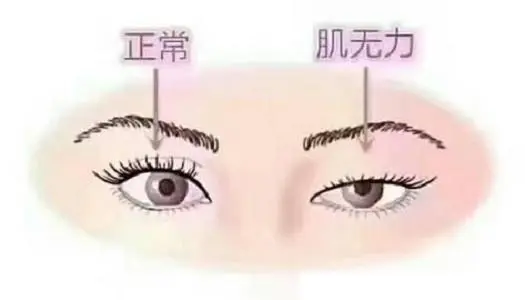 【科普小课堂】重症肌无力眼肌型会发展为全身型吗?