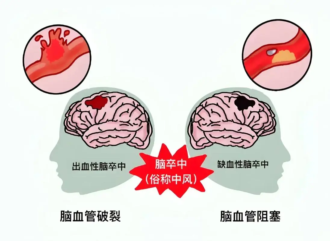 脑卒中后的挑战:患者为何日渐消瘦?