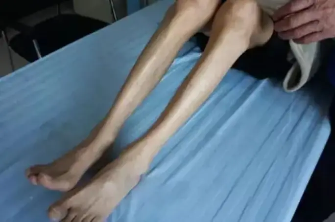 肌肉萎缩患者注意:医生提醒科学锻炼恢复肌肉力量要这样做