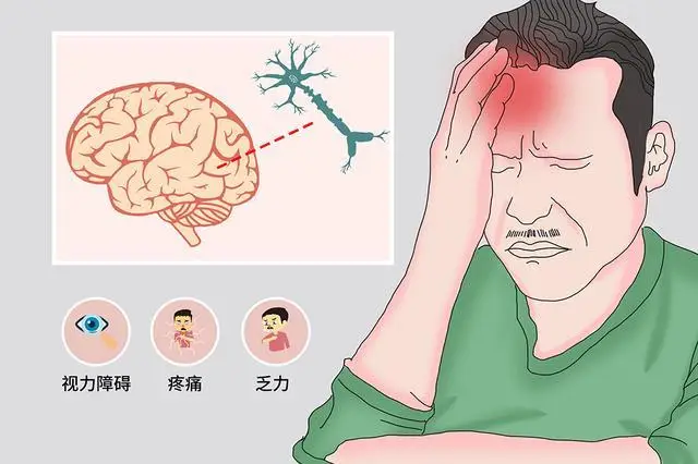患者须知丨头脑晃动:脑出血患者不可忽视的后遗症及其管理