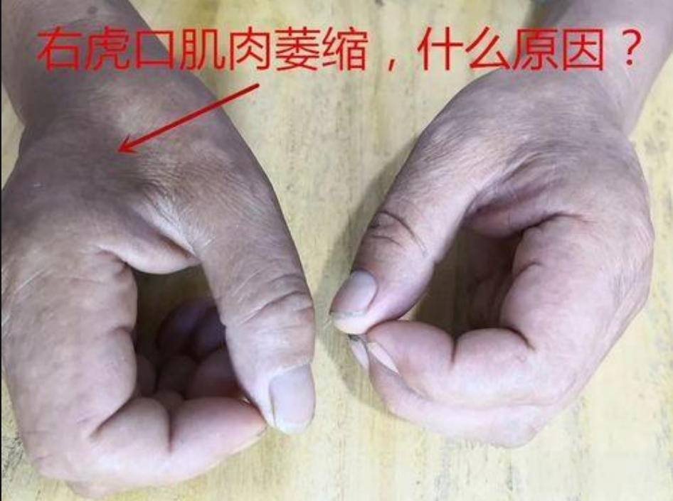 虎口肌肉萎缩:运动神经元损伤的早期预警?