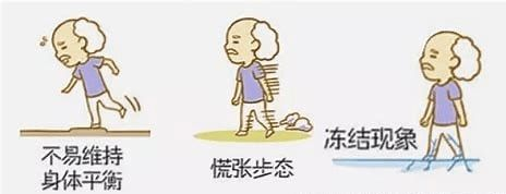 7种异常步态:解码神经系统疾病引发的步态谜团
