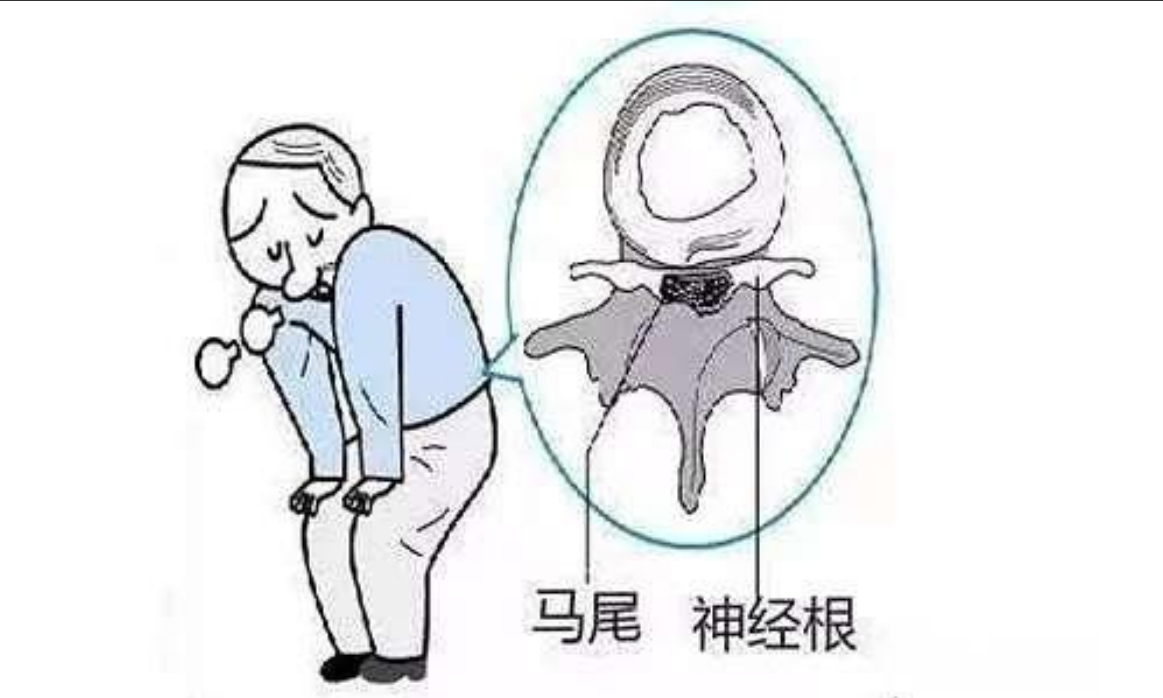 马尾神经损伤引发的神经源性膀胱症状：患者的应对策略