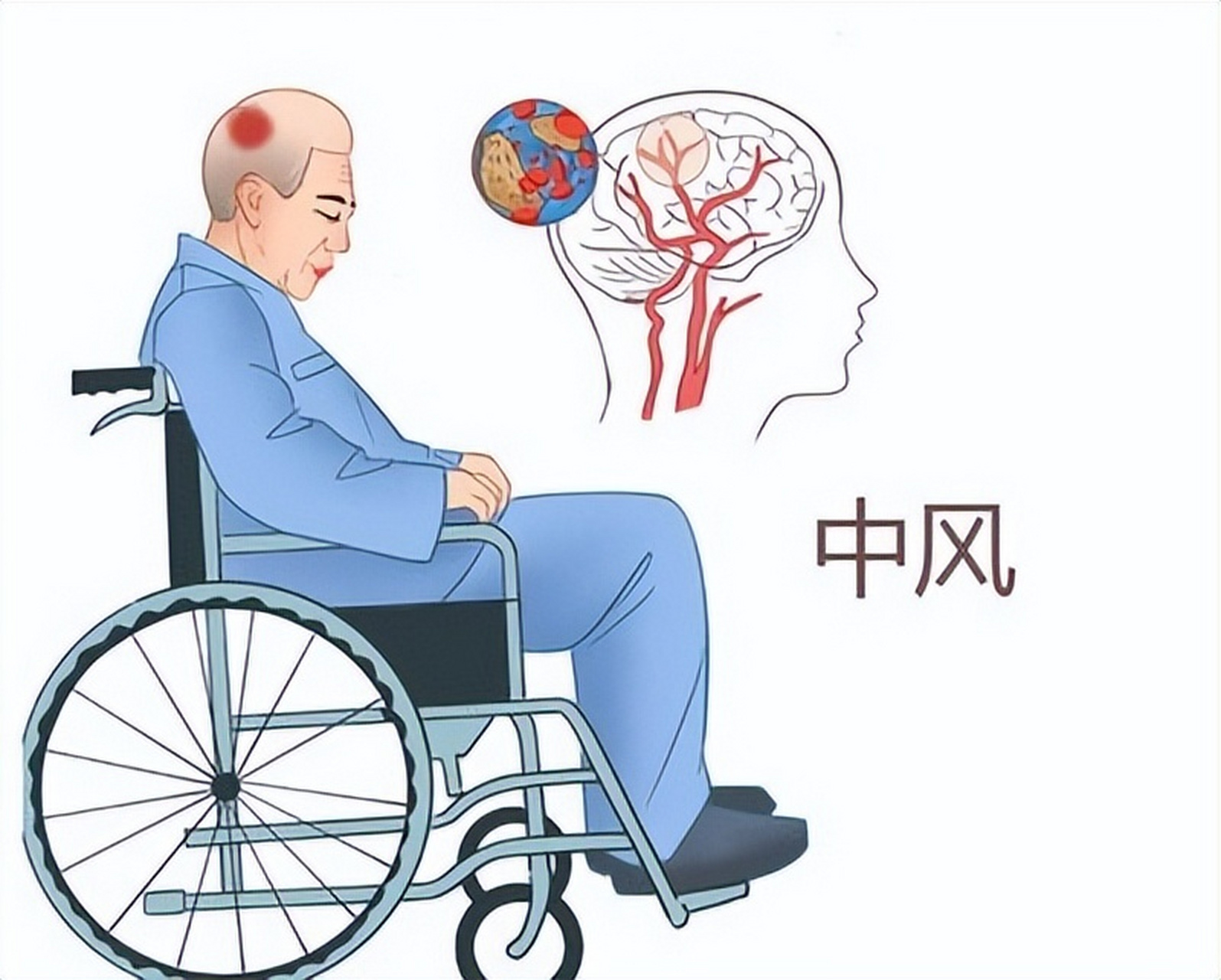 脑中风后遗症:偏瘫侧肢体无力,如何应对?
