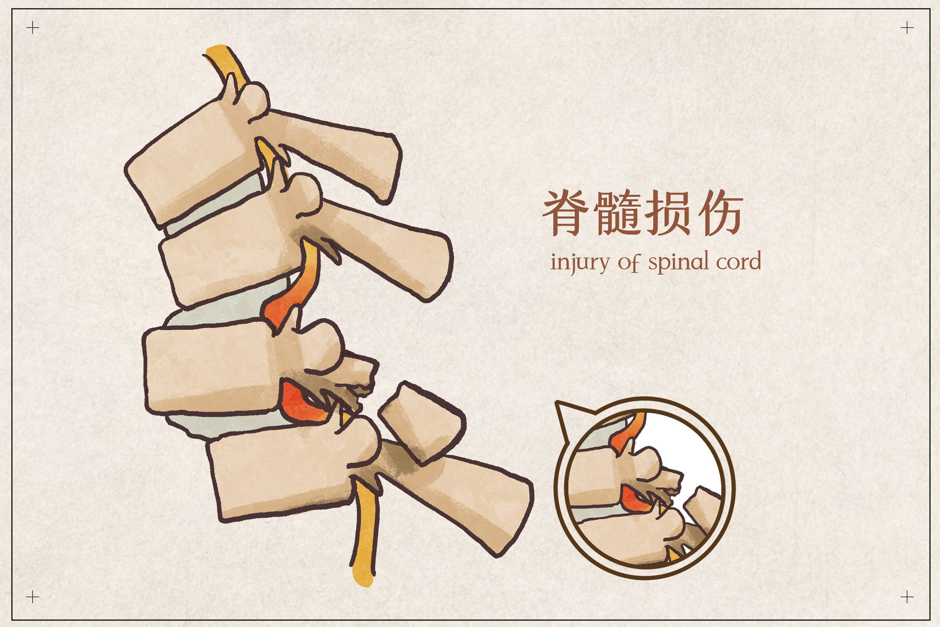 脊髓损伤卧床患者的饮食策略