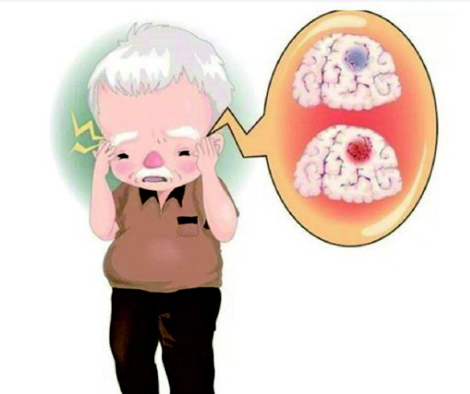 冬季脑梗高发期:脑梗患者如何避免复发?