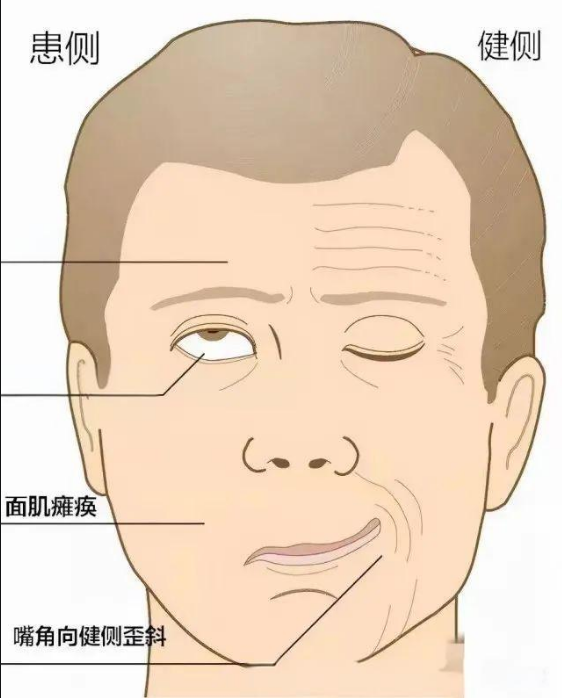 面瘫恢复时间线:面神经损伤后多久能恢复正常?