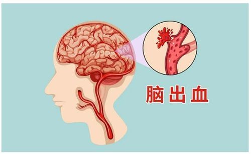 脑出血后腿发沉僵硬怎么办?医生教你如何应对