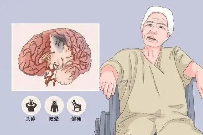 脑梗后手脚无力?这些康复小技巧,让你轻松应对!