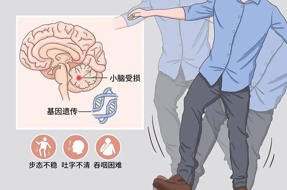 家庭行走训练指南|共济失调患者居家康复秘籍