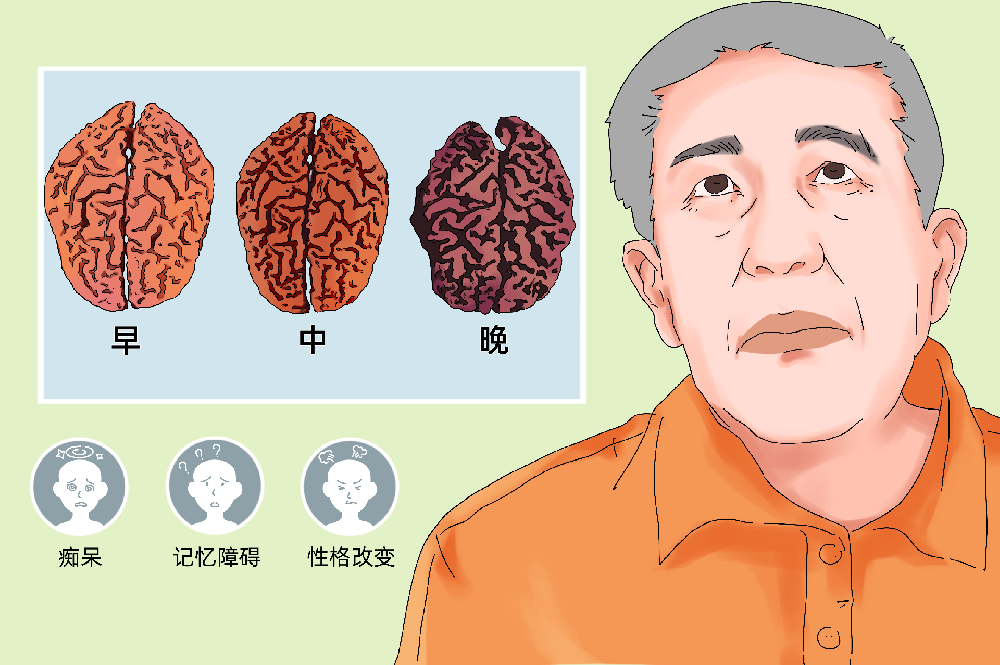 脑萎缩如何演变为痴呆?一文读懂