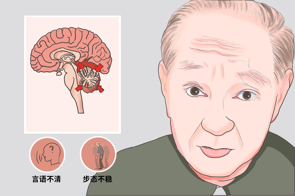 从轻度到重度:脑萎缩如何一步步缩短生存期?