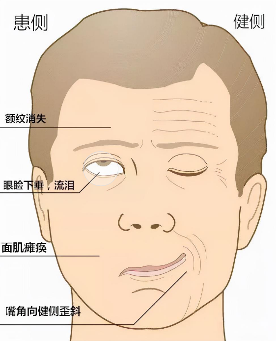 面瘫自愈可能性有多大?科学数据告诉你