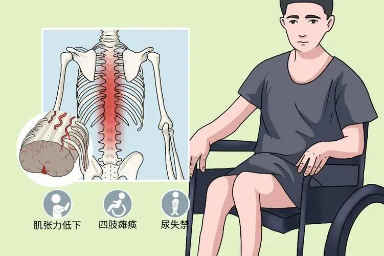 居家康复必备:脊髓损伤患者大小便失禁自我管理技巧