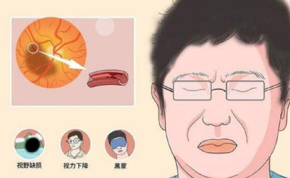 视神经萎缩不治疗,多久会失明?