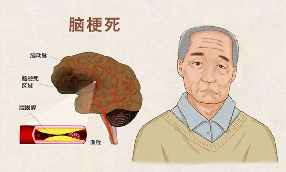 【案例纪实】七旬老人脑梗昏迷险成植物人!神经修复让他从