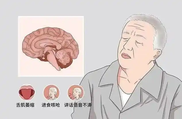 肌萎缩侧索硬化症:远不止“硬”那么简单