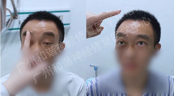 【案例纪实】神经修复攻克重症肌无力 20 年顽疾,眼睑下垂终改善,睁眼不再艰难|广州重症肌无力该怎么治疗呢?