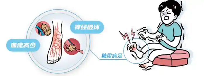 糖尿病周围神经病变患者饮食“禁区”:一口糖=加速神经坏死