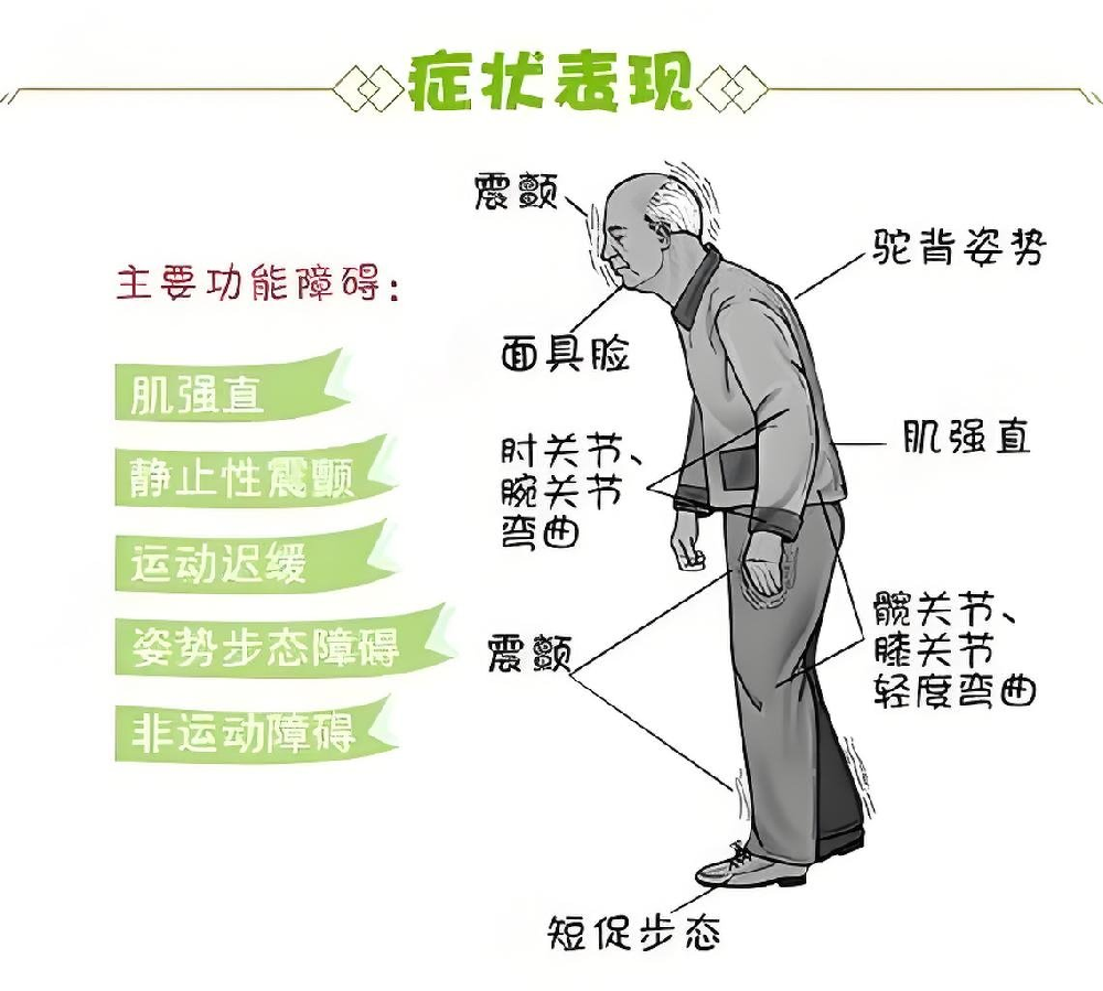 患者关注点:帕金森肢体僵硬会影响寿命吗?