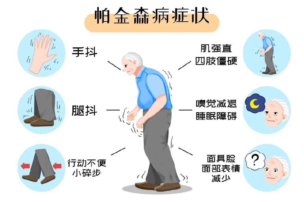 【纪实案例】被帕金森冻住一年多?肢体发僵?活动受限?神经修复显效,成功摆脱抖僵慢困扰,行动灵活