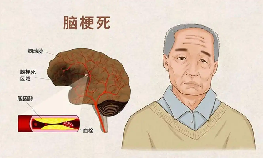 脑梗后遗症的这些迹象:说明神经功能正在恢复