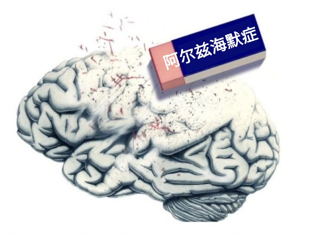 阿尔茨海默症：不只是老年人的问题