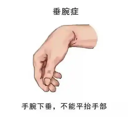 手腕无力下垂?小心是臂丛神经损伤了