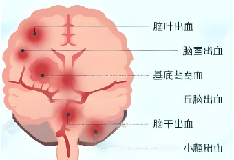 脑出血位置不同,后果天差地别!一文看懂4种常见出血的信号