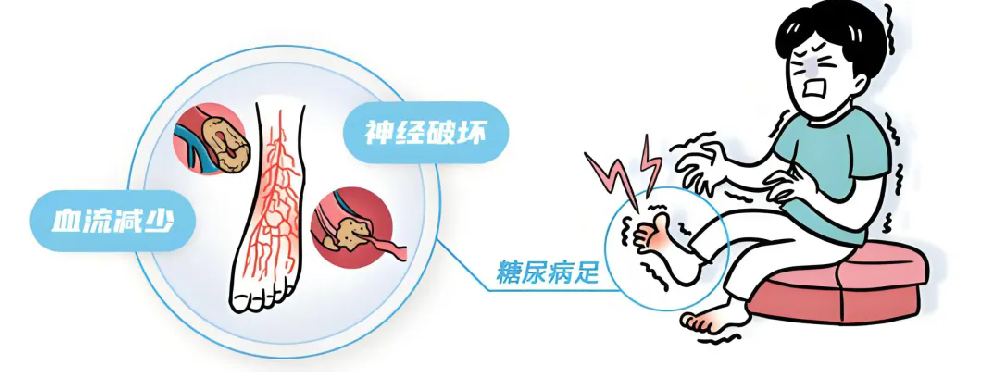 糖尿病周围神经病变:别等脚烂了才重视!这3个阶段信号,糖友必须早识别