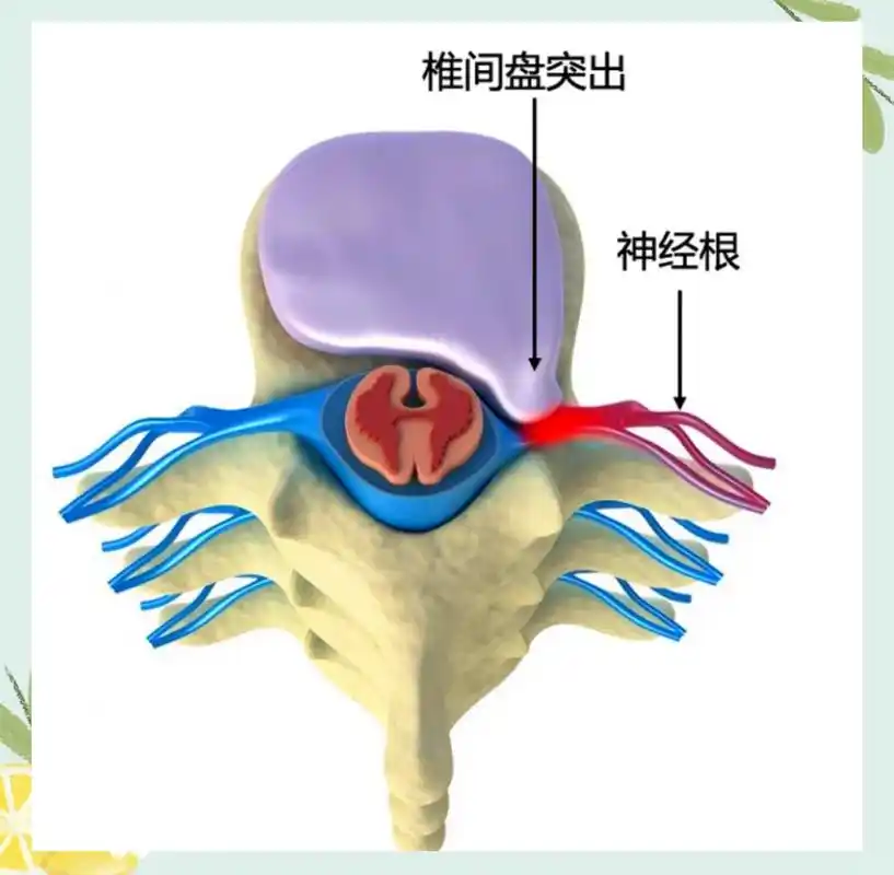 别忽视!神经受压的7个阶段,别拖到严重才后悔